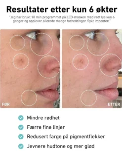LED-lysmaske til ansikt mot akne, rynker og pigmentflekker